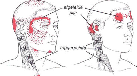 triggerpoints-tekening